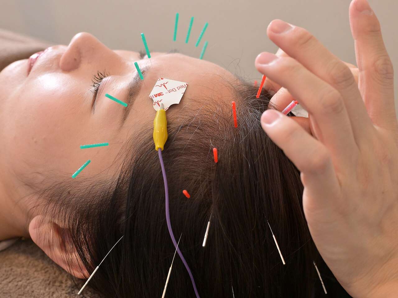 美容鍼は1回で変わる 即効性の考え方
